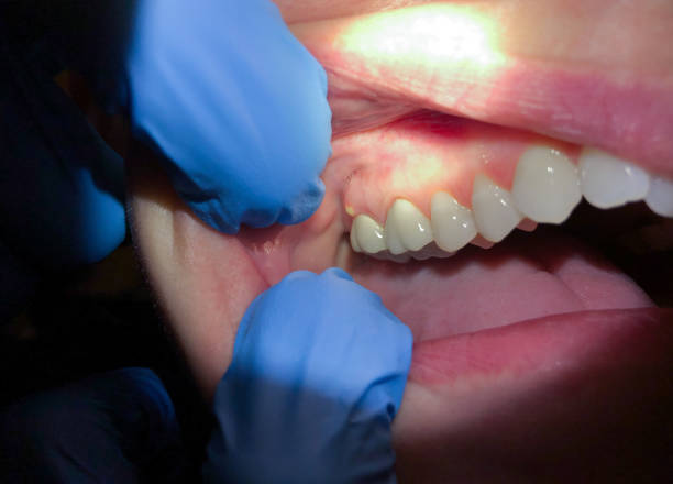 Best Emergency Dental Extractions in Ashland, AL