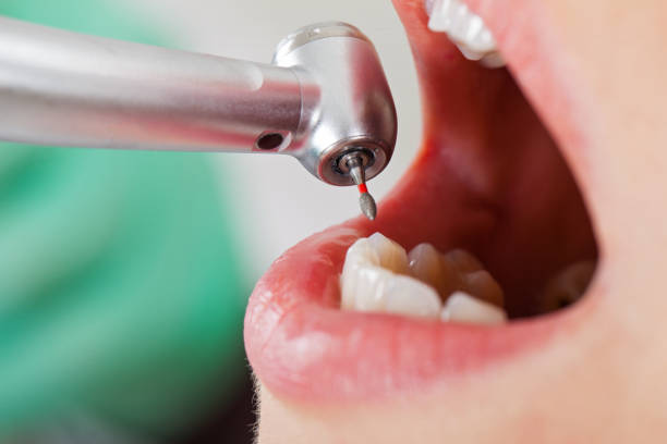 Best Emergency Dentist for Lost Fillings or Crowns in Ashland, AL